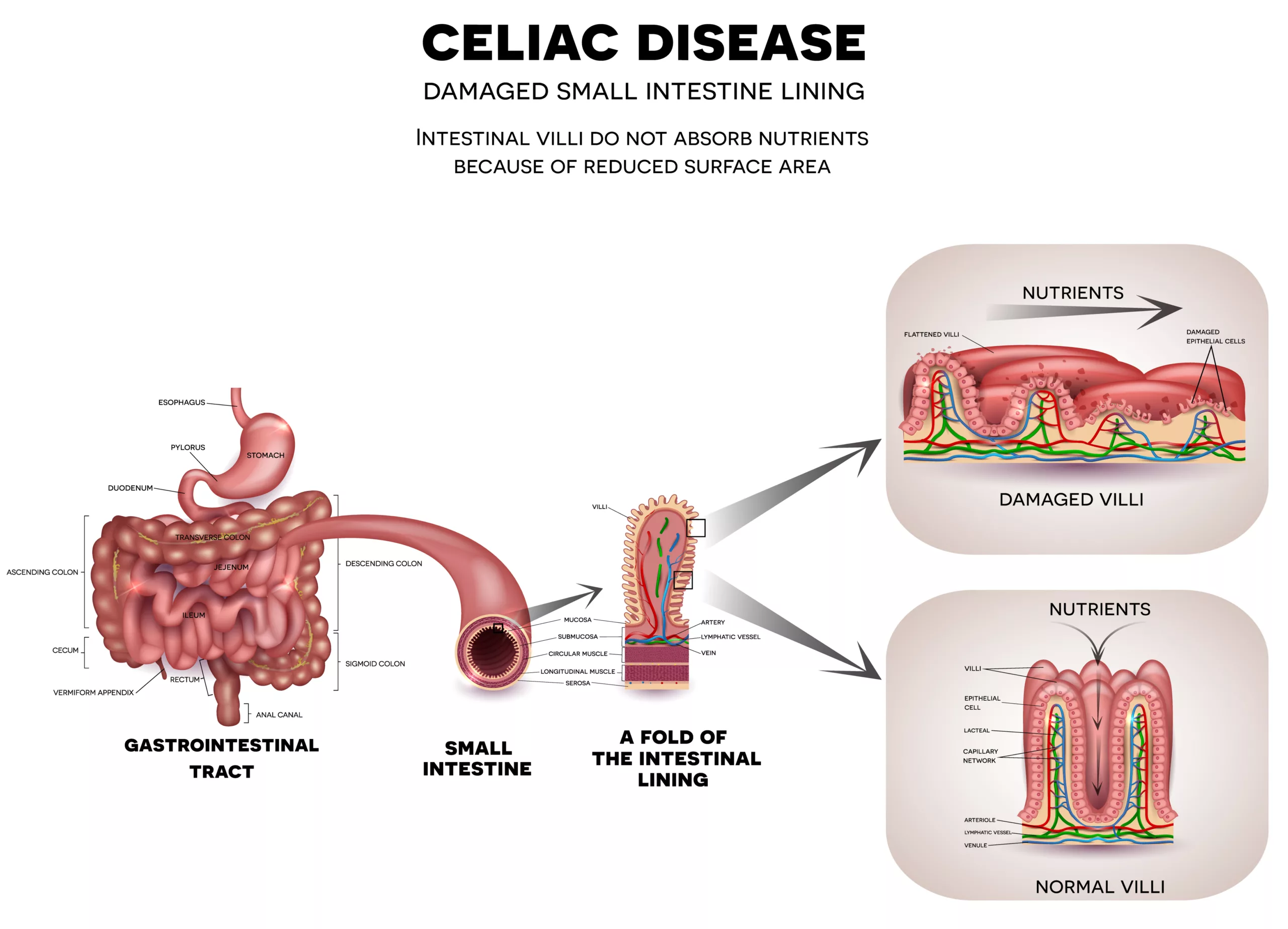 Gastrointestinal tract anatomy and Celiac disease affected small intestine villi. Unhealthy villi with damaged cells and healthy villi. Intestinal villi do not absorb nutrients because of reduced surface area.