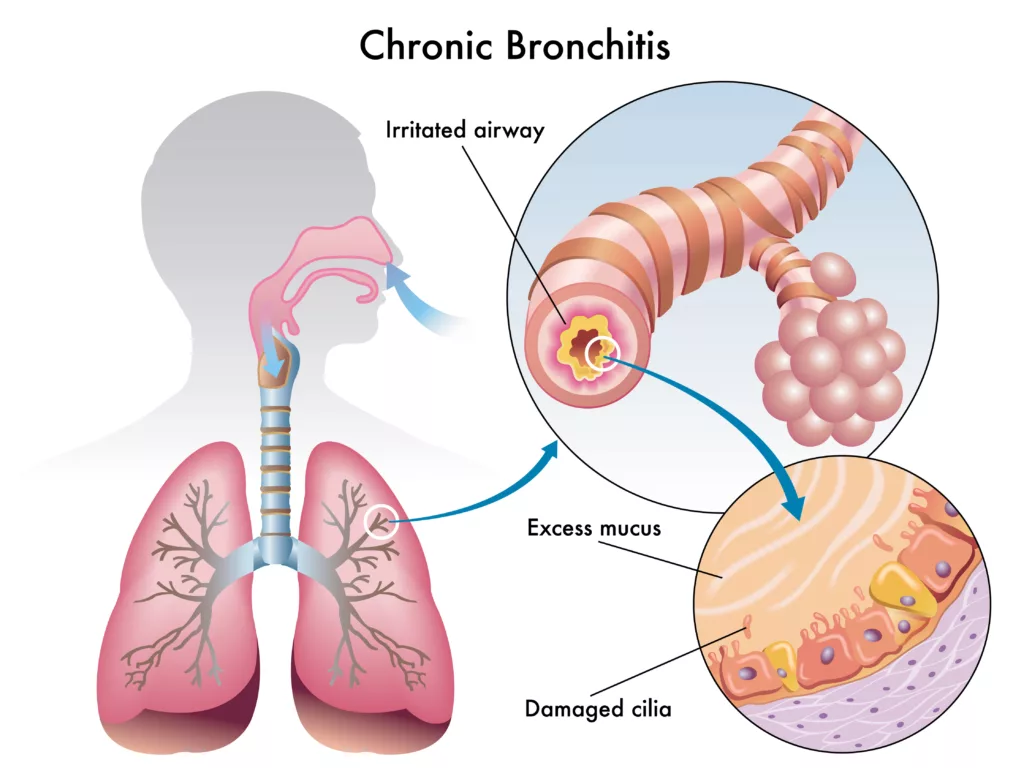 Bronchite cronica