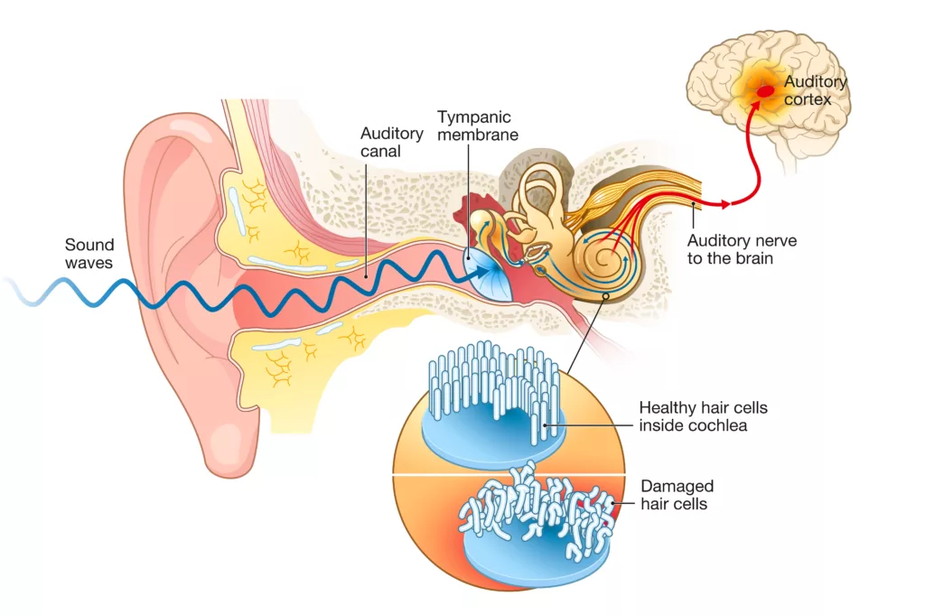 Tinnitus. Damaged hair cells inside cochlea