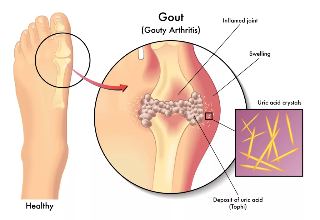gout graphic